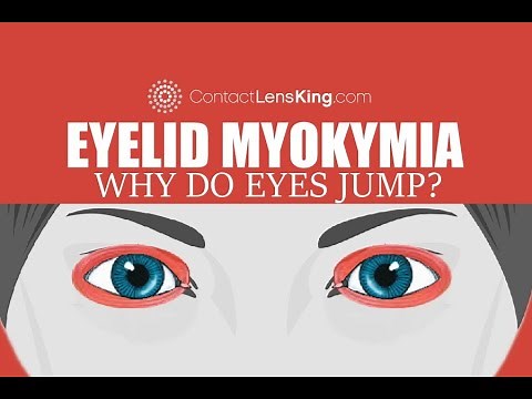 Eyelid Myokymia | Why do my eyes keep jumping?