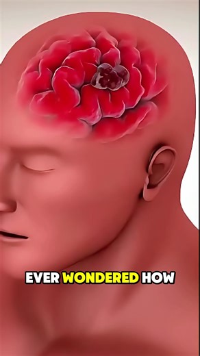 HOW Brain Aneurysm Treatment (3D Animation) Brain aneurysm treatment is done to prevent rupture or stop bleeding in the brain. Doctors may perform surgical clipping, where a small metal clip is placed at the base of the aneurysm through open brain surgery. Another method is endovascular coiling, where tiny coils are inserted through a catheter to block blood flow into the aneurysm. Both methods aim to secure the weak blood vessel and prevent life-threatening bleeding. #brainaneurysm #neurosurger