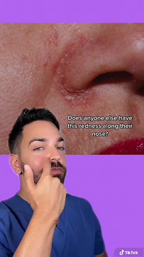 Scaly rash on the corner of the nose? Still relevant 2 years later #seborrheicdermatitis