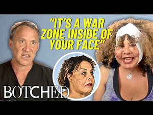 Botched OG Rajee Returns for a Third Time to Remove MORE Facial Lumps | Botched | E!