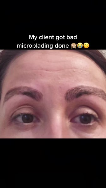 Botched Microblading Eyebrows - Dr. Nadine Yassa