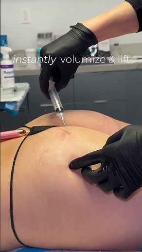 Non-surgical Liquid BBL | Beverly Hills