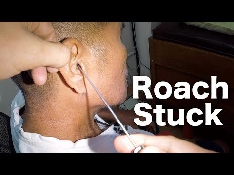 Cockroach Stuck in Elderly Man's Ear | How It's Removed