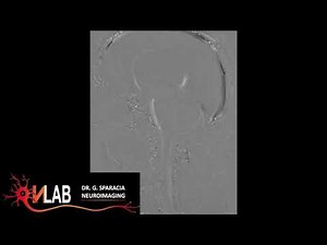 3D Cine MR CSF Flow Imaging