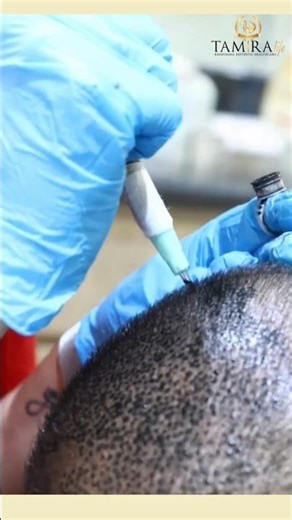 This Hair Tattoo Saved His Hairline #smp #hairtattoo #baldness