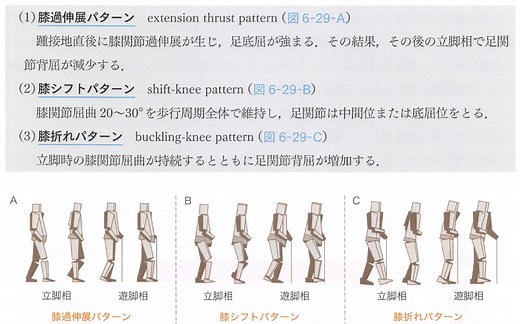 【2022年最新】脳卒中後の片麻痺歩行とは？予後予測、障害、歩行分析、理学療法、リハビリテーションまで