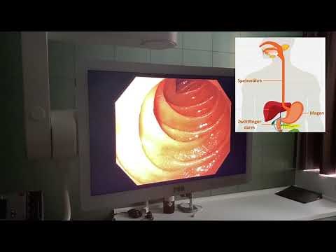 #MediMittwoch 8: Magenspiegelung (Gastroskopie)