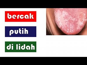 BERCAK PUTIH DI LIDAH || LEUKOPLAKIA