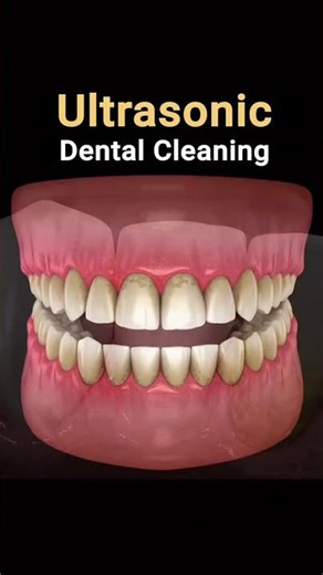 All about Ultrasonic Dental Cleaning 🦷💯. #dentistry #universaldentalgaya