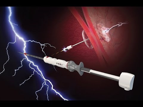 UEGW Booth Lecture 2022 - Introduction of the ZEUS-IT stent (MI Tech)