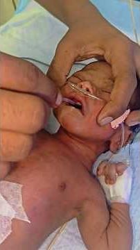 OG Tube Insertion Step by Step in Newborn Baby | 😍 #shorts #youtubeshorts #newbornbaby #nicu #baby
