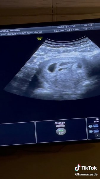 Meet the Castle Quadruplets! Heartwarming Ultrasound Reveal