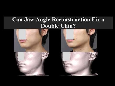 Can Jaw Angle Reconstruction Fix a Double Chin?