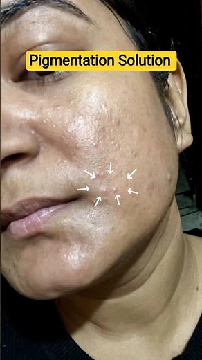 The Derma Co Hyperpigmentation serum Review ‼️✨#pigmentation #hyperpigmentation #darkspots #skin