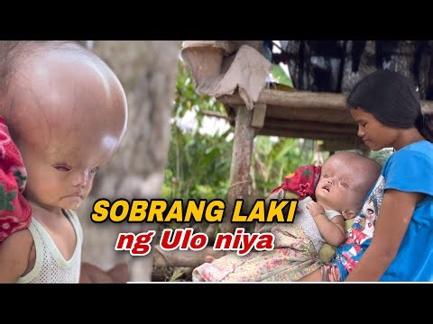 ANG BATANG SOBRANG LAKI NG ULO SA BUNDOK