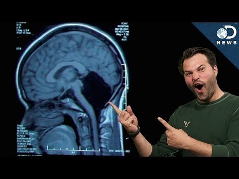 How Can You Survive Without Part Of Your Brain?