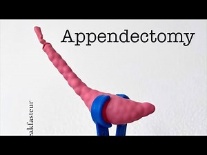 Playdough Surgery 🔪🪱 - Open Appendectomy