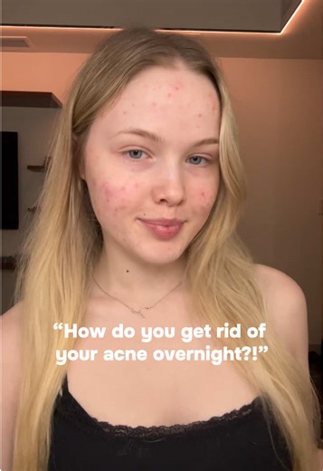 “How do you get rid of your acne overnight?!” 🙅‍♀️💗 #makeup #GRWM #fyp #storytime #relatable