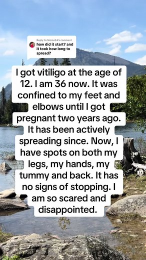 Living with Vitiligo: A Personal Journey
