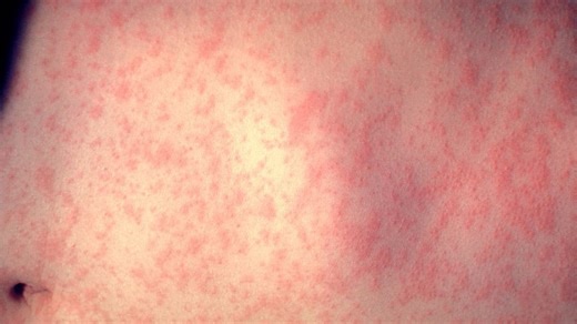 Measles cases in Oconto County stay at 36, all unvaccinated
