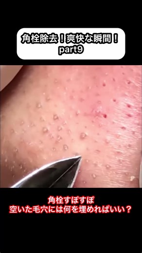角栓抜きやばいハマる#角栓 #角栓除去 #角栓抜き #毛穴 #pimples #pimples_brufoli #blackhead #blackheads #blackheadsremoval