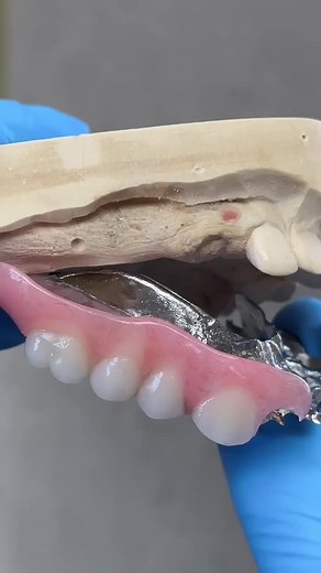 #protesisdental #cromocobalto #prolabcenter #Quevedo