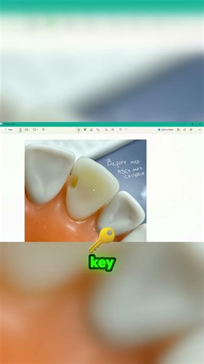 The #1 Mistake Dentists Make with Prep Modifications