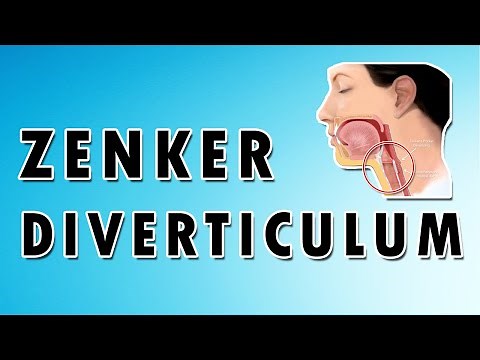 Zenker's Diverticulum