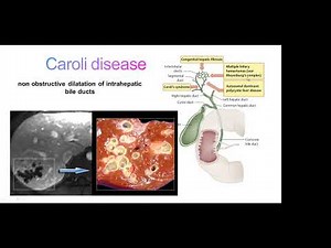 Caroli disease