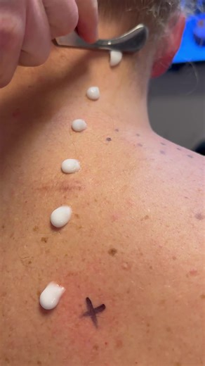 🏆 Instrument Assisted Soft Tissue Mobilization (IASTM) helps break up scar tissue and fascial restrictions using specially designed tools. This technique promotes better circulation, restores mobility, and speeds up recovery from overuse or injury. #IASTM #SoftTissueTherapy #ChicagoChiropractic #Chiropractor#drkyleross