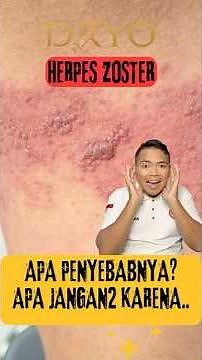 What is Herpes Zoster?