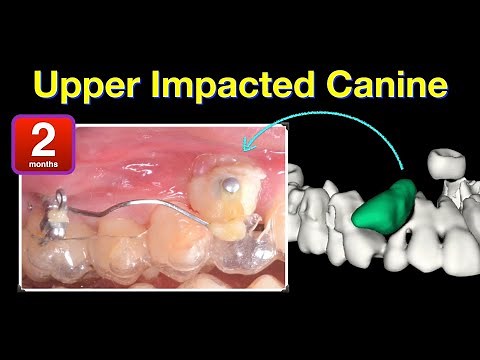 Upper Impacted Canine: Orthodontic & Aligner treatment｜【Chris Chang Ortho】CC667