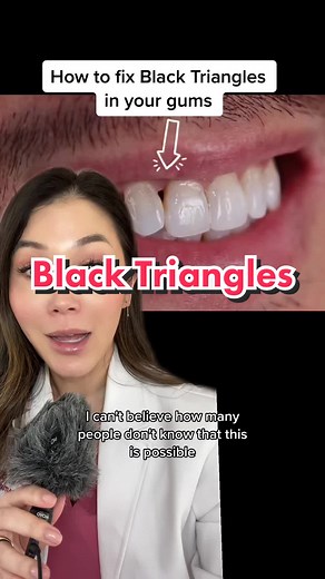 All about Black Triangles! Why they happen and how we can treatment them :) #dentist #blacktriangles #bioclear