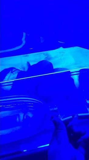 Neonatal Jaundice 😧 Causes, Symptoms & Treatment Understanding #viral