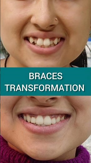 BRACES Transformation: Before and After; Dr. Srishti Bhatia #braces #smilemakeover #smile