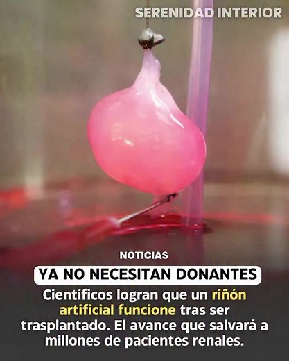 🩺🧬 YA NO NECESITAN DONANTES: UN RIÑÓN ARTIFICIAL DA UN PASO HISTÓRICO Científicos de Estados Unidos, liderados por investigadores de la Universidad de California en San Francisco (UCSF) y Vanderbilt University, lograron que un riñón bioartificial funcionara con éxito tras ser trasplantado en estudios experimentales. El dispositivo combina células renales vivas con tecnología de filtración para imitar las funciones de un riñón humano. 🔬✨ Aunque el desarrollo aún se encuentra en fase de investi