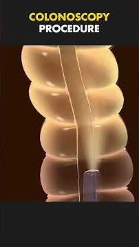 Colonoscopy Explained: Step-by-Step Procedure & What to Expect