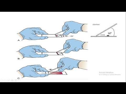 Preparation of peripheral blood smear