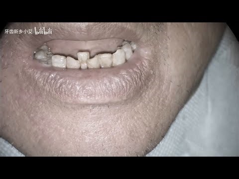 Fix the loose tooth!