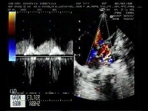 Cor Triatriatum (2/2) • Video • MEDtube.net