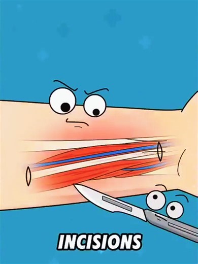 Understanding Tendon Grafting in Surgery