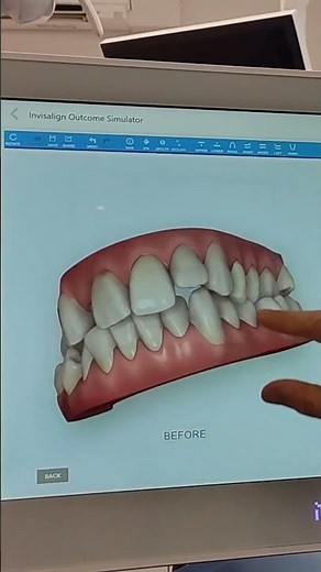 My teeth straightening journey begins! Angel aligners