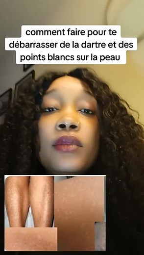 Astuces pour se débarrasser de la dartre et des points blancs