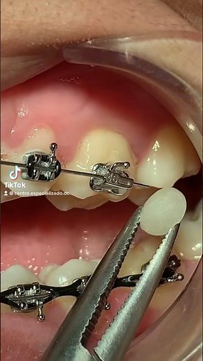 ¿ Que hacer si lastima el alambre de los BRACKETS ?