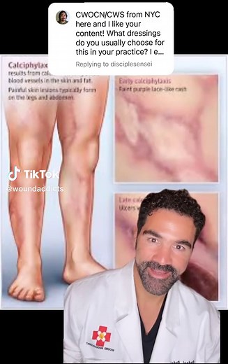 Understanding Calciphylaxis: Treatments and Care Tips