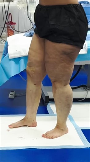 “That looks like a totally different leg!” 😍 This is 360° Cankle and Knee Liposuction for lipedema, performed by Dr. George Kardashian. By removing lipedema fat completely around the lower leg, patients see immediate transformation — improved mobility, reduced pain, and smooth, natural contours. Our advanced awake technique allows patients to stand throughout the procedure so every angle can be perfected in real time. Unlike traditional surgeons who often remove only 50% of fat, Dr. Kardashian 