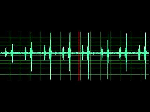 Pulmonary Associated Heart Sounds (PAH)- Split S2