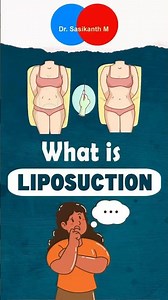 What Is Liposuction? How It Removes Stubborn Body Fat Explained | Dr. Sasikanth