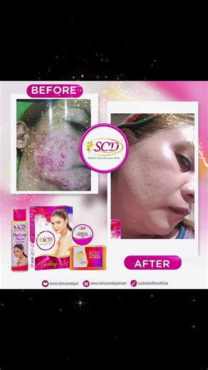 Achieve Radiant Skin with SCD Peeling Set