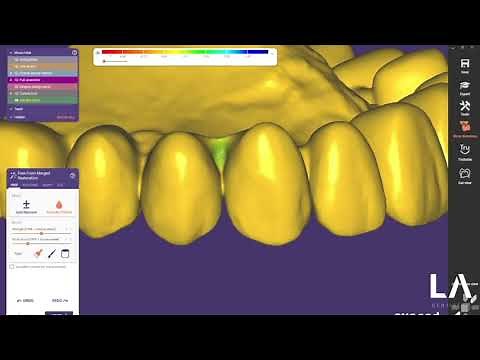 FP1 Multifunctional Guide Design in EXOCAD